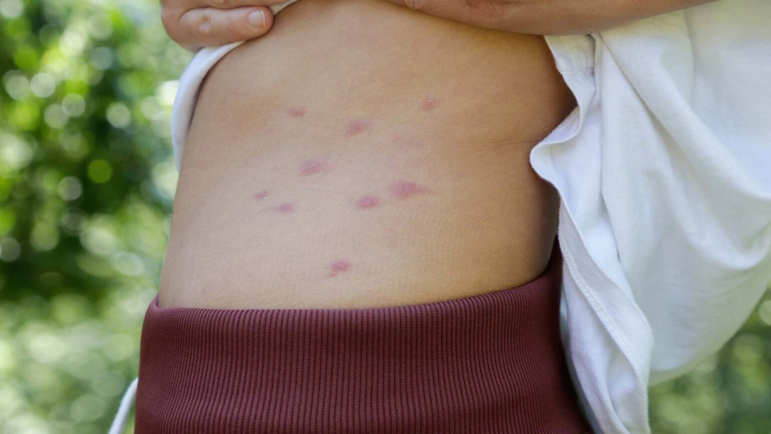 Do Bed Bug Bites Itch?