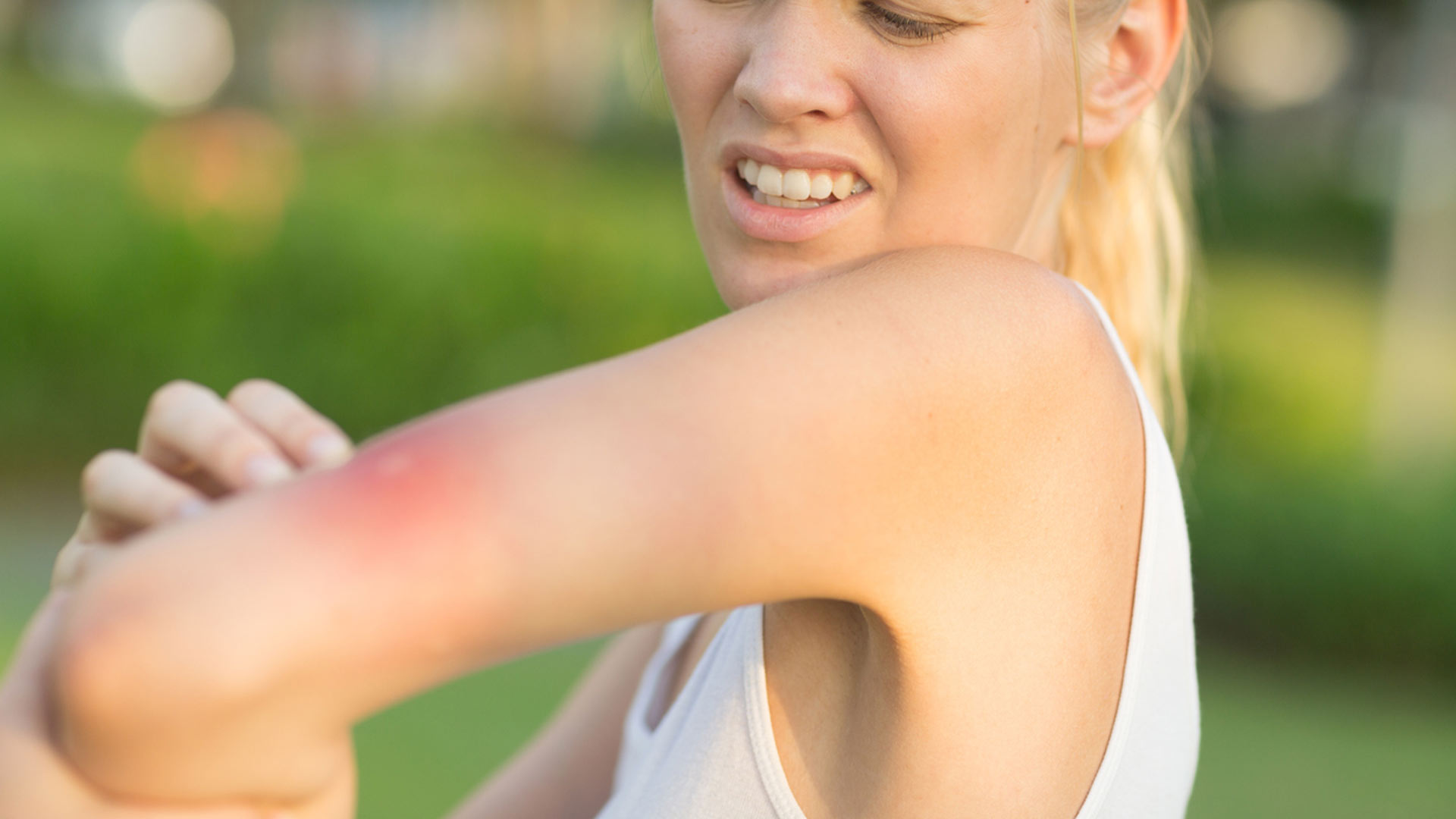 blonde woman with bad mosquito bite on her arm